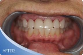 Restored smile after denture treatment