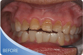 Teeth before denture treatment