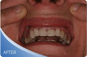 Restored smile after full mouth rehabilitation treatment
