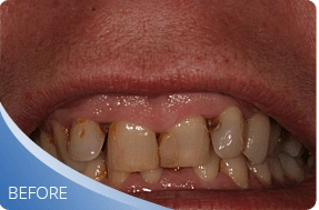 Teeth before full mouth restoration treatment