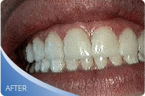 Improved smile after dental veneer treatment