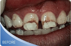 Teeth before dental veneer treatment