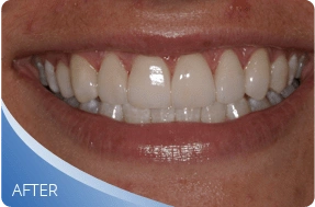 Whiter teeth after professional teeth whitening treatment