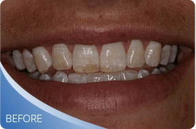 Teeth before professional teeth whitening treatment