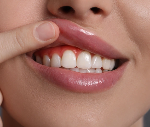 Gums bleeding around the teeth