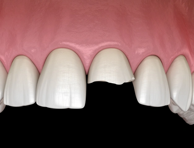 Illustration of damaged teeth with chipped and broken areas