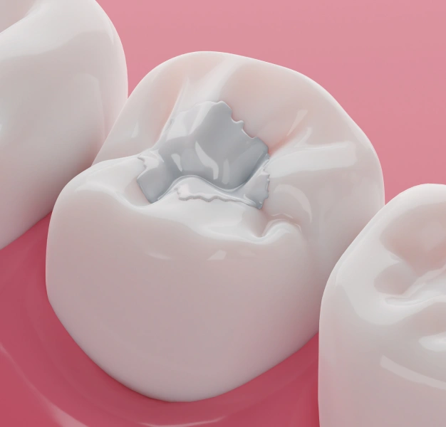 Composite filling being placed to restore a damaged tooth