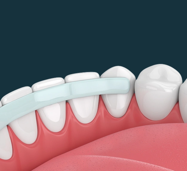 Dental bonding material being applied to a tooth