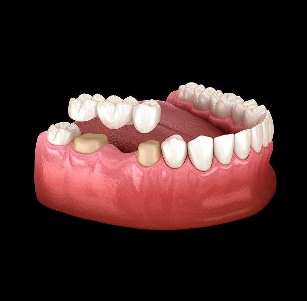 Dental bridge shown replacing missing teeth