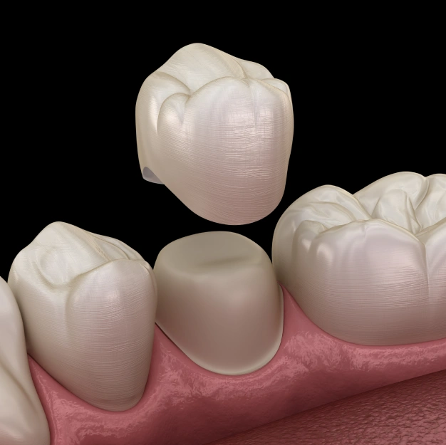 Dental crowns shown for restoring damaged teeth