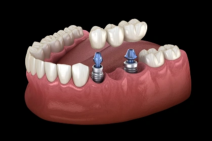 Dental implants supporting a full arch dental restoration