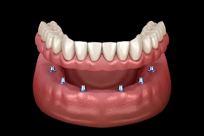 Implant-supported dental restoration replacing missing teeth