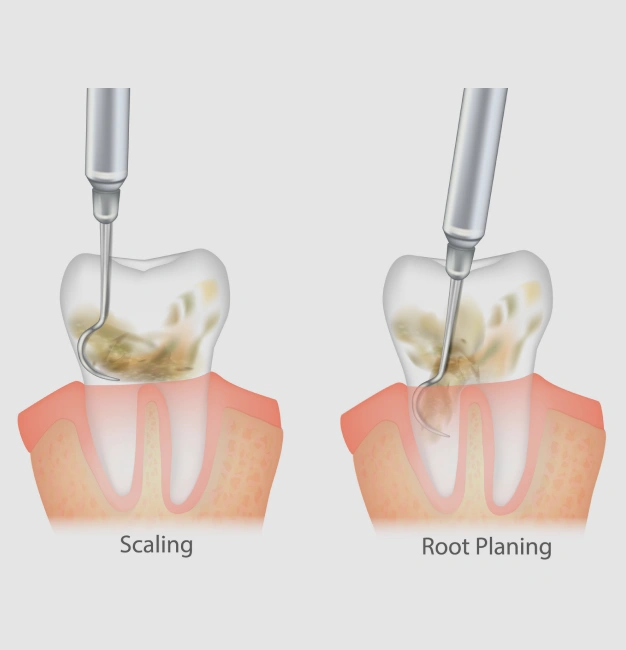 Dental instruments used for deep gum cleaning