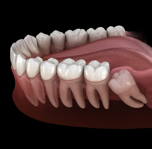 Illustration showing impacted wisdom teeth requiring extraction