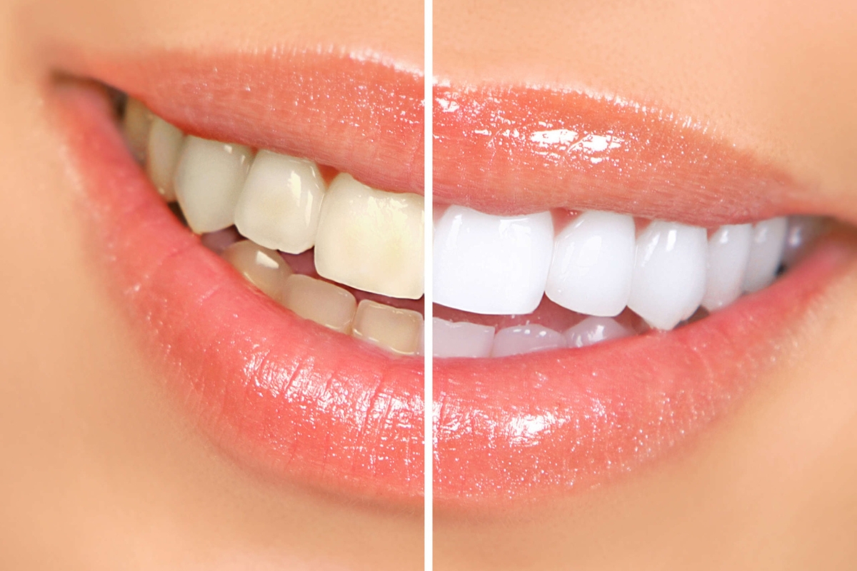 Close-up smile demonstrating results from professional teeth whitening treatment in Payson