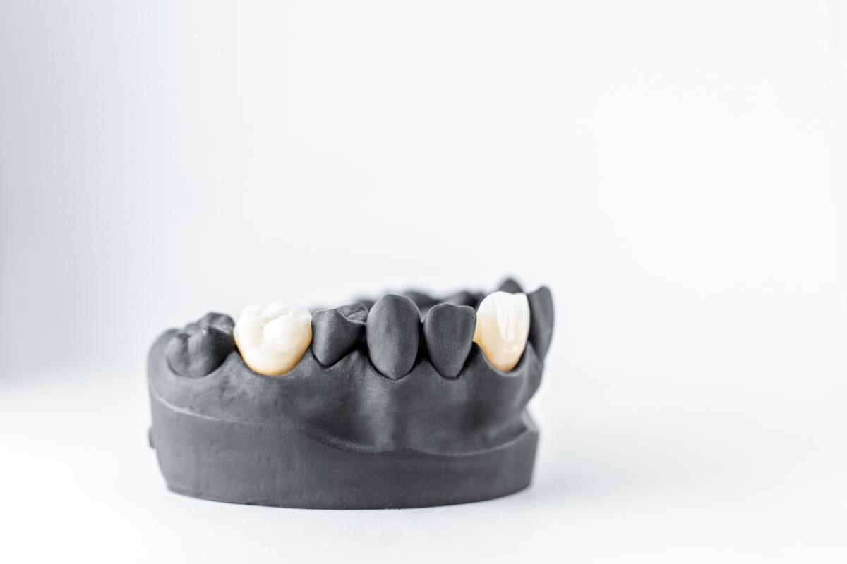 Black dental arch model showcasing natural-looking tooth-colored dental crowns in Payson